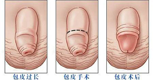 九江市_哪个治包皮_